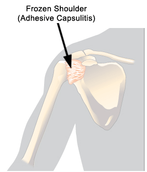 Frozen Shoulder