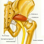 piriformis_syndrome
